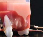 اهمیت نگهداری ایمپلنت دندان